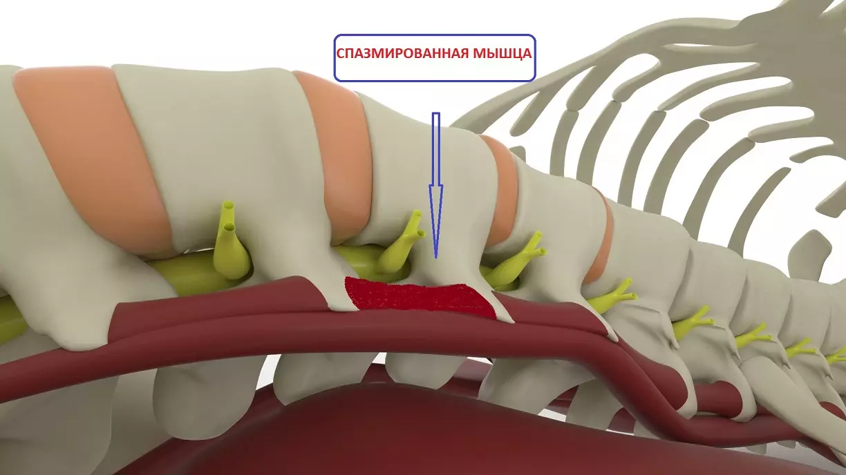 Рчд позвоночника. Спазм мышц позвоночника. Спазмированные мышцы. Спазмированные мышцы спины. Мышцы поясничного отдела позвоночника спазмированы.