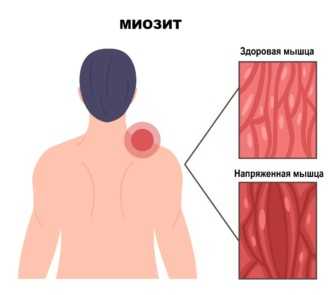 Миозит симптомы