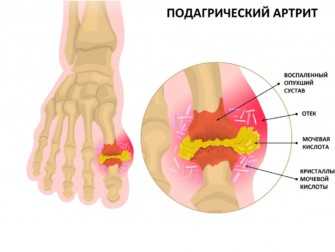Подагрический артрит стопы симптомы