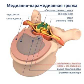 Грыжа мпд картинки