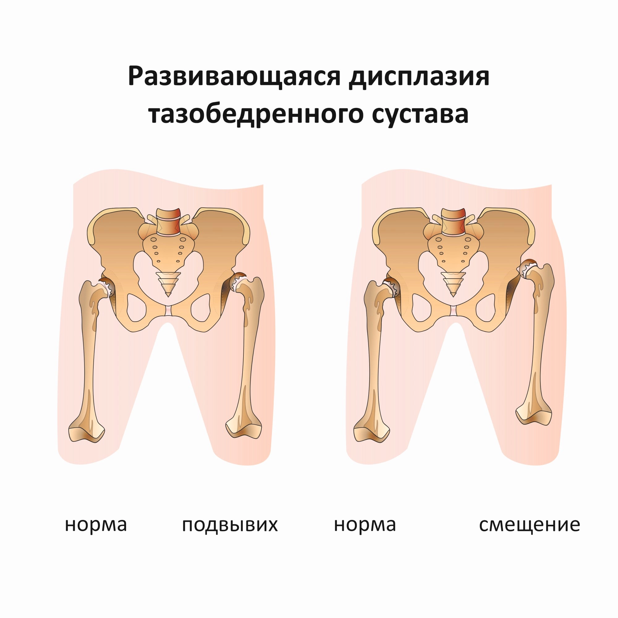 Презентация дисплазия тазобедренных суставов