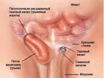 Пах человека. Прободная грыжа паховая. Канатиковая паховая грыжа. Паховомашоночная грыжа. Операция паховая мошоночная грыжа.