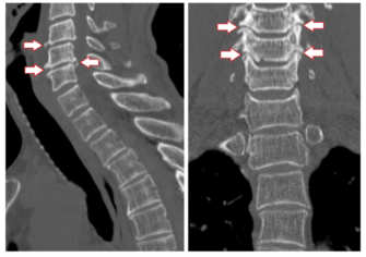 Признаки спондилеза шейного отдела. Спондилоартроз шейного отдела позвоночника мрт. Спондилез шейного отдела рентген. Деформирующий спондилез грудного отдела позвоночника рентген. Спондилез шейного отдела позвоночника рентген.