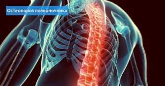 Остеопороз позвоночника. Остеопороз позвонка от бюстгальтера. CT Osteoporosis immobilization also known.