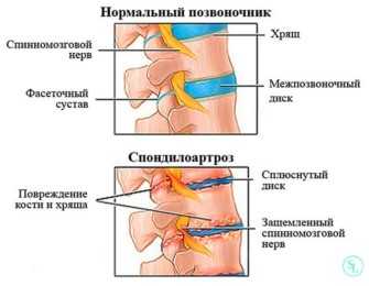 Фасеточные суставы позвоночника картинки