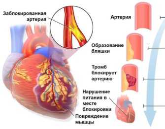 Клиническая картина инфаркта миокарда имеет признаки