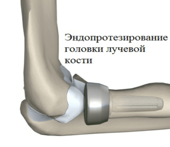 Перелом локтя после операции. Эндопротез головки лучевой кости. Перелом головки лучевой кости локтевого сустава. Остеосинтез головки лучевой кости. Головка лучевой кости локтевого сустава.