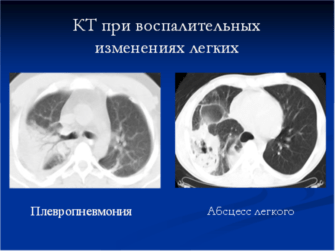 Кт при пневмонии. Кт легких. Компьютерная томография легких при пневмонии. Кт легкого при пневмонии. Снимки кт при воспалении лёгких.