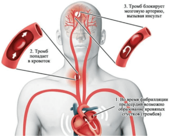 Инсульт сердца
