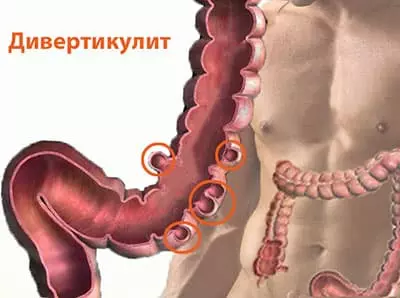 Дивертикулит что это. Дивертикулит кишечника. Дивертикулит толстой кишки. Что такое дивертикулит Толстого кишечника. Выпячивание Толстого кишечника.