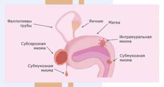 Месячные при миоме