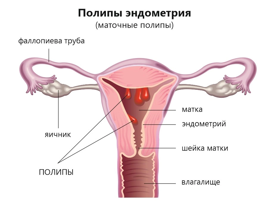 Сосудистый рисунок выражен в матке что это значит