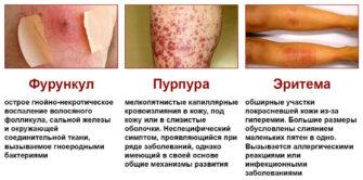 Аллергическая реакция